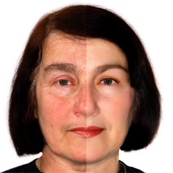 Botox Treatment Results